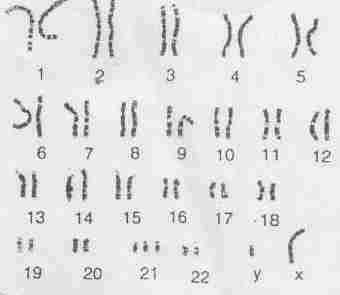 what chromosome is SCIDS on